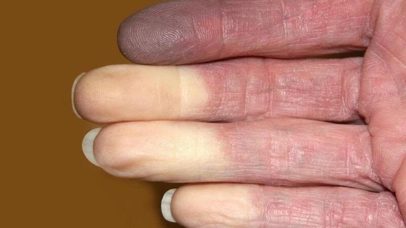 Hội chứng Raynaud có thể dẫn đến móng dễ gãy