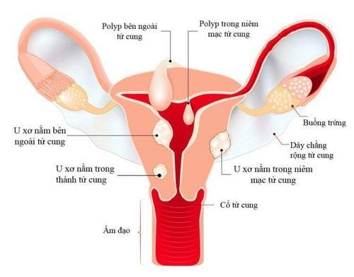 U tử cung có thể là nguyên nhân dọa sảy thai